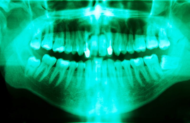 Are Dental X-Rays Safe? Understanding Radiation Exposure
